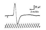 Sensory nerve action potential