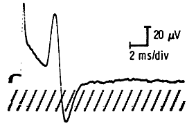Sensory potential with loose active electrode (left), motor (right)
