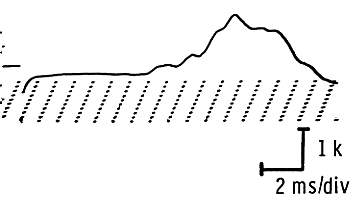 Temporal dispersion in demyelinating conditions
