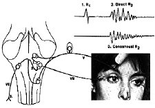 Blink reflex pathway - trigeminal and facial nerve connections