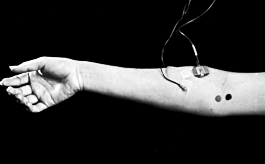 H-reflex in soleus and flexor carpi radialis