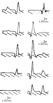 H-reflex amplitude changes with increasing stimulation