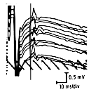 F-wave shape and latency differences