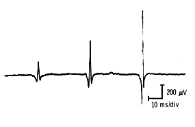 Effect of needle distance on amplitude