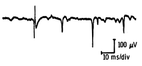 Fibrillation potentials