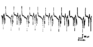 Complex repetitive discharges