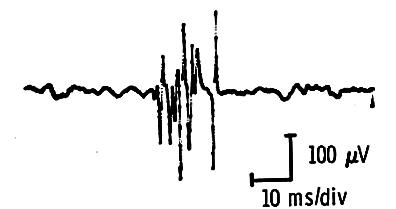 Nascent motor unit potentials