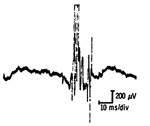 Chronic neurogenic motor unit