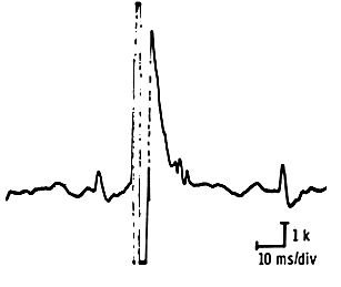 Giant motor unit potentials