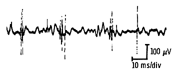 Myopathic motor units