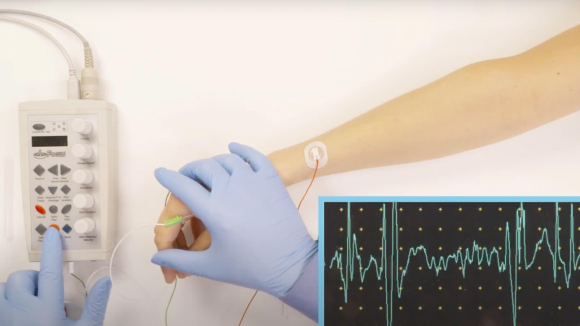 EMG Needle Exam - First Dorsal Interosseous (FDI)