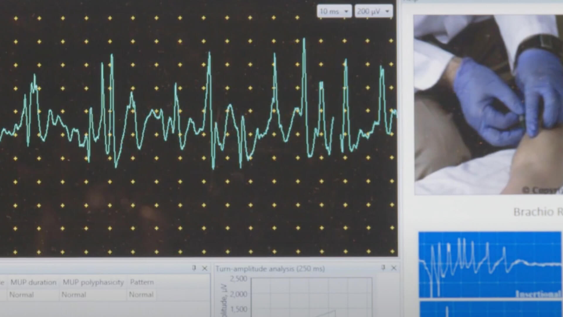 EMG Needle Exam - Brachio Radialis (BR)