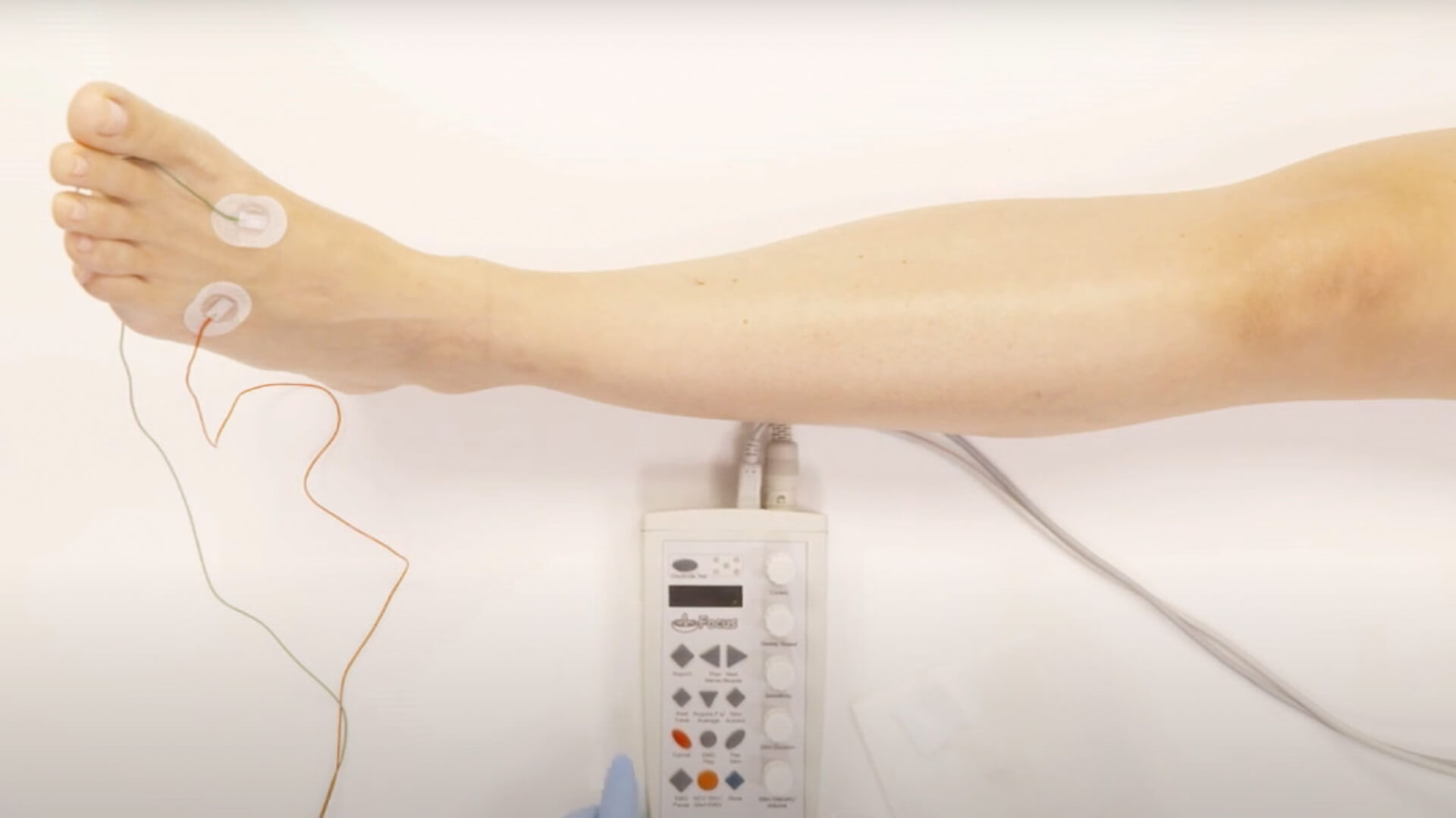 EMG Needle Exam - Extensor Digitorum Brevis (EDB)