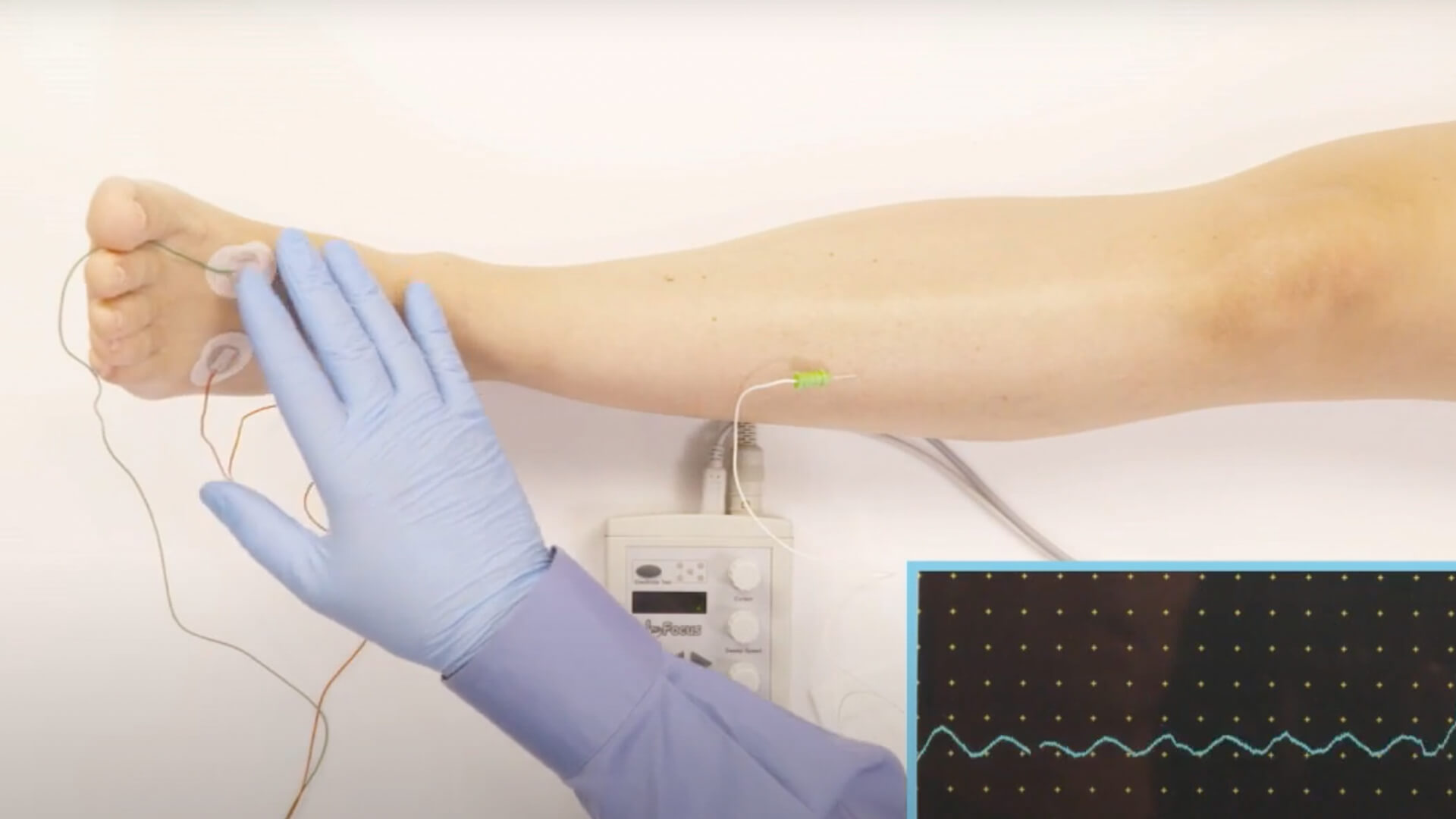 EMG Needle Exam - Tibialis Anterior (TA)