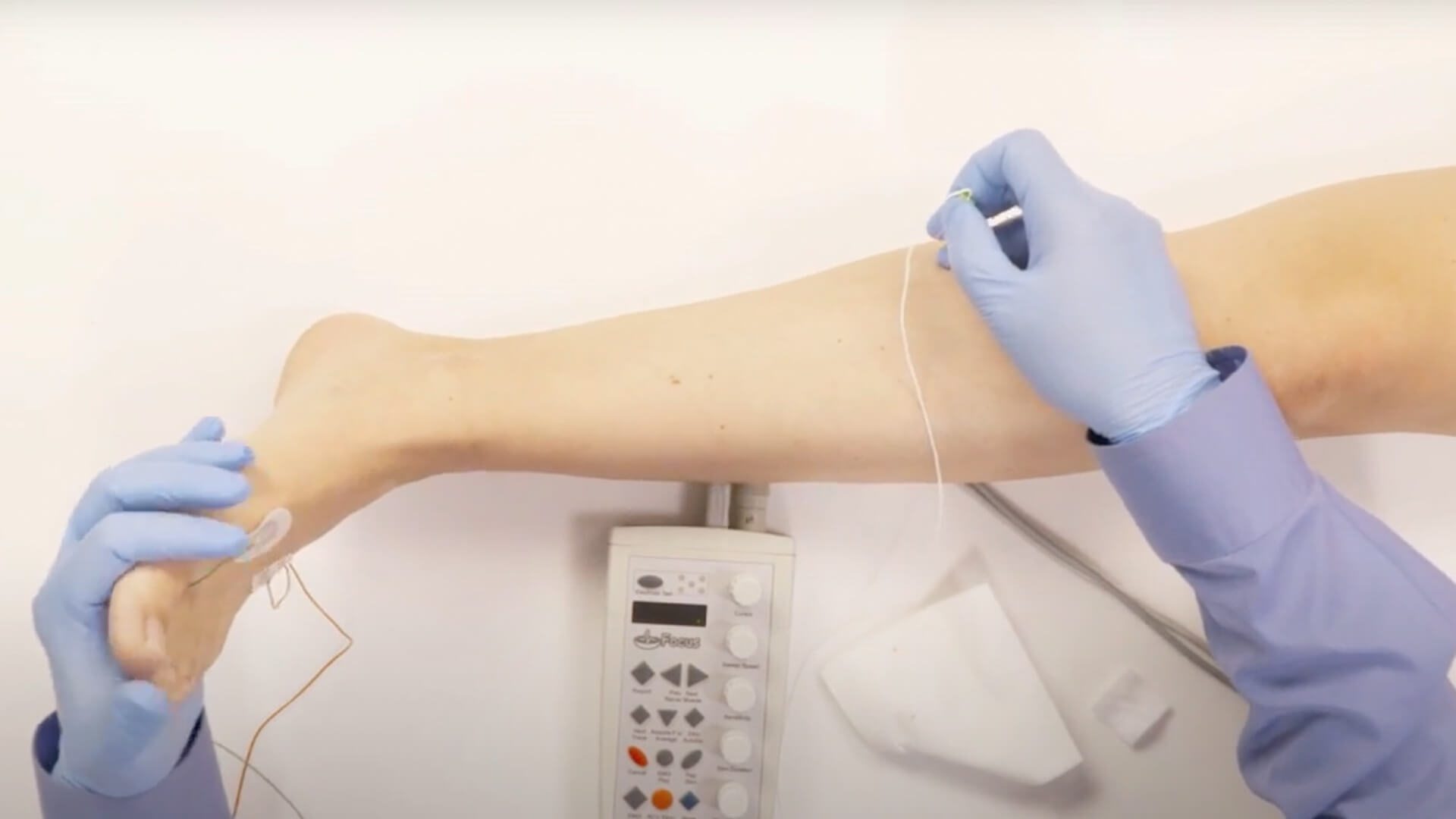 EMG Needle Exam - Medial Gastrocnemius