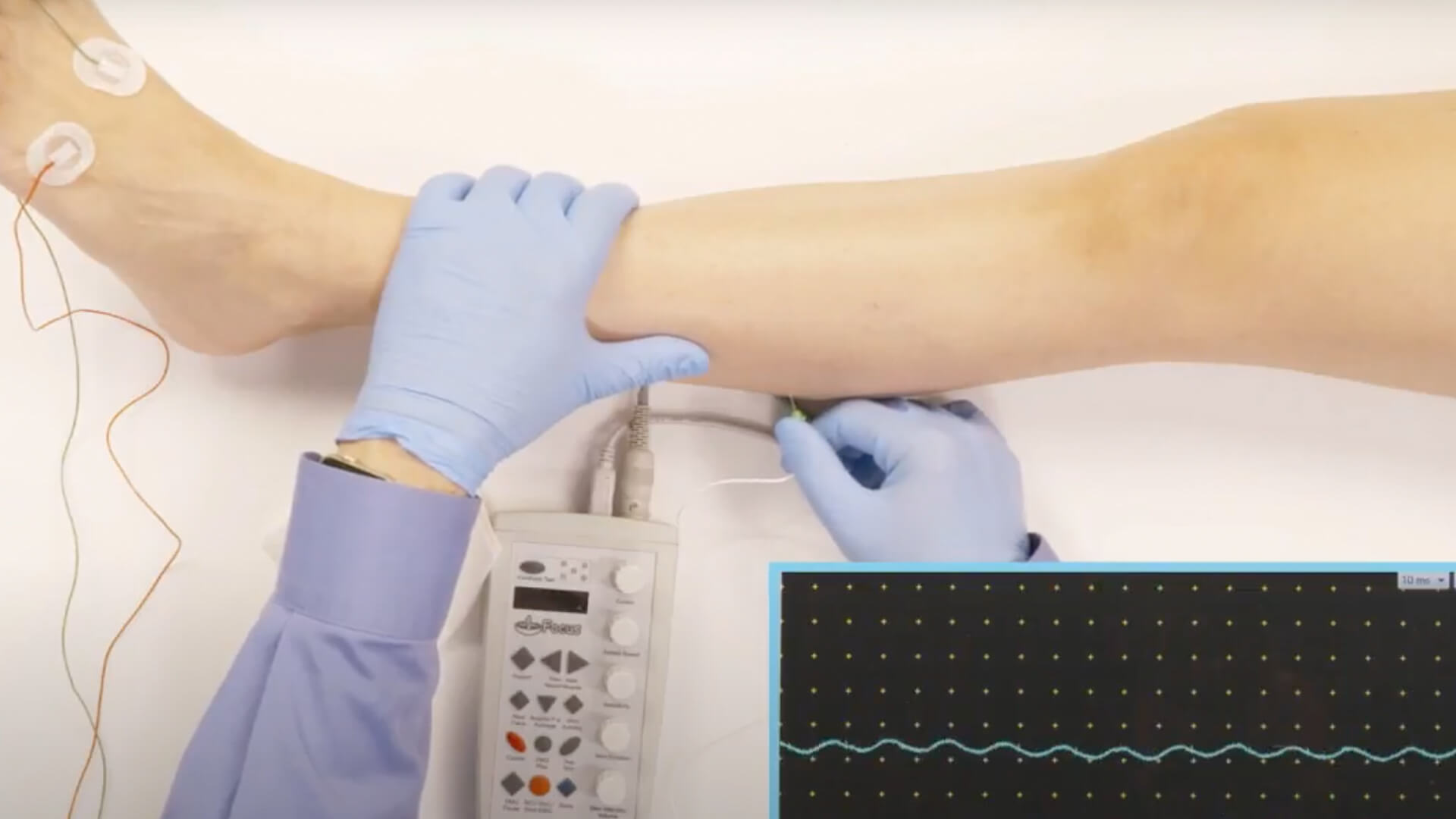 EMG Needle Exam - Lateral Gastrocnemius (LG)