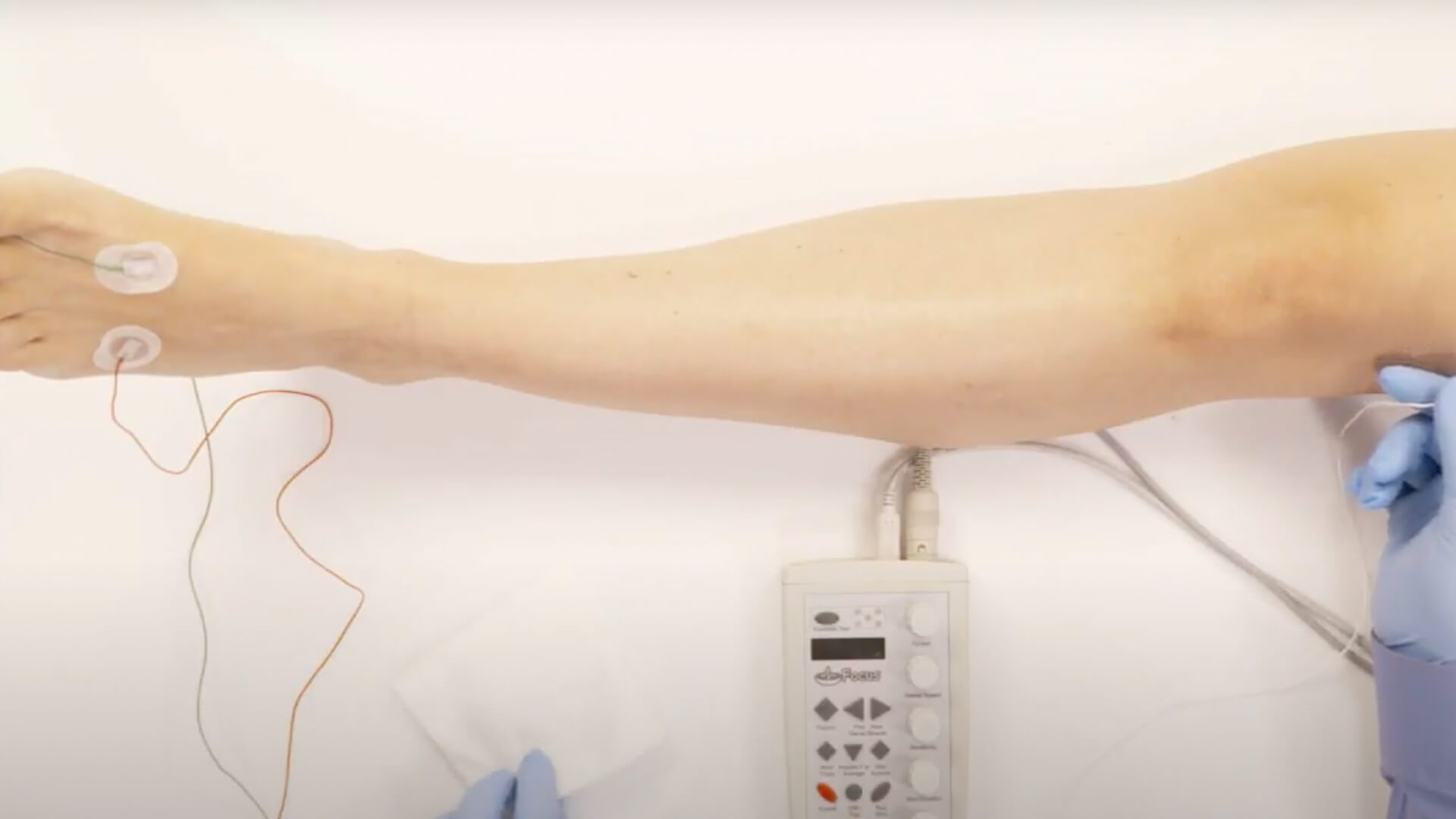 EMG Needle Exam - Vastus Lateralis (VL)