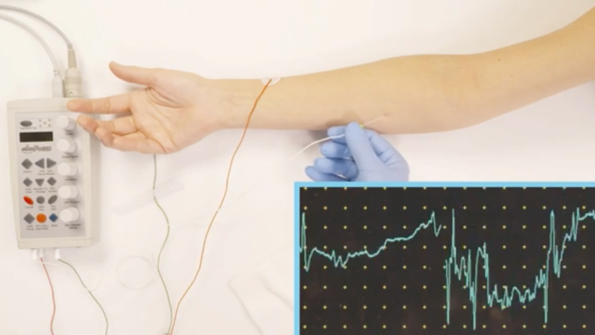 EMG Needle Exam - Flexor Carpi Radialis