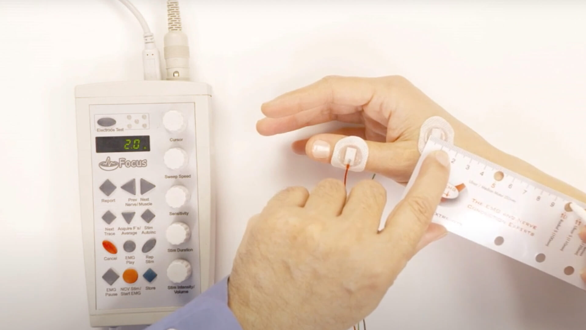 NCV Exam - Radial Sensory