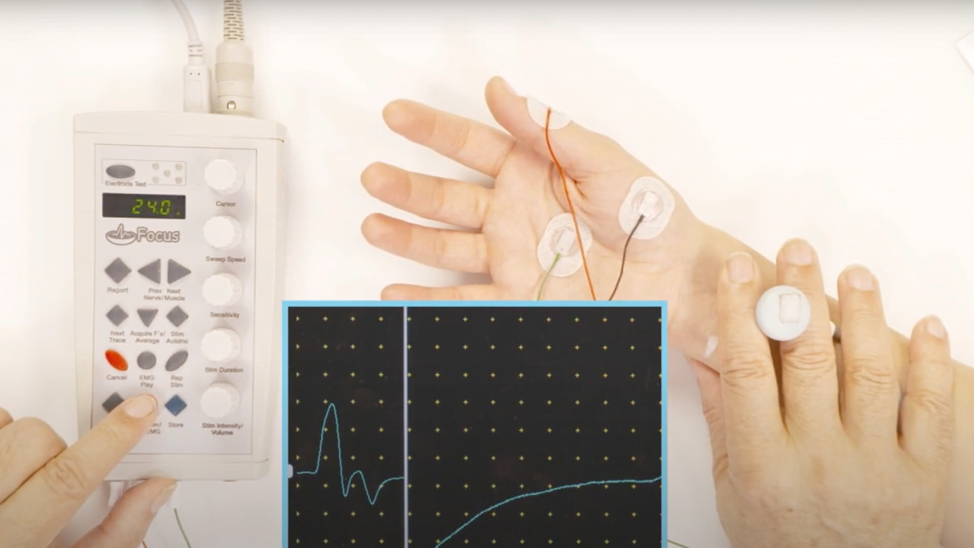 NCV Exam - Median Motor with F-wave
