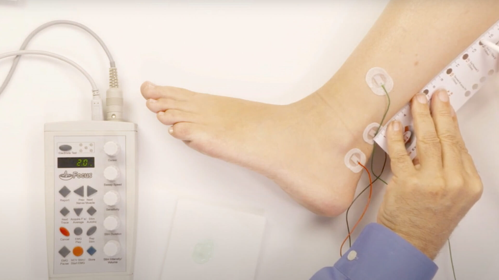 NCV Exam - Sural Sensory