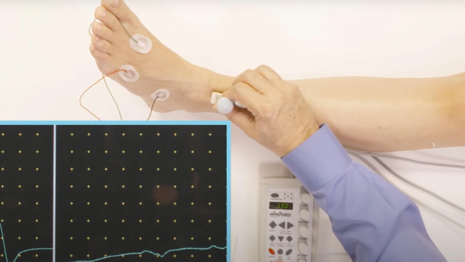 NCV Exam - Peroneal Motor with F-wave